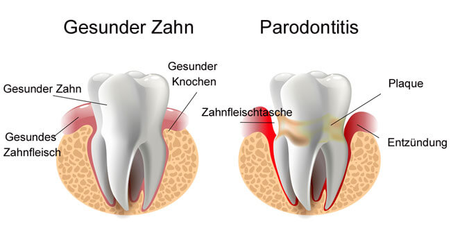 Parodontitisbehandlung Wien 1010