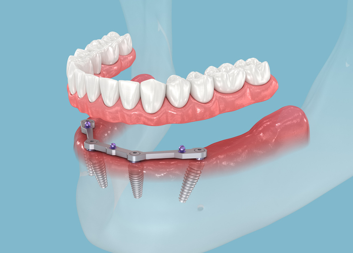 All on 4 Implantate